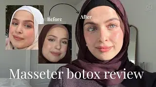 Masseter botox review | pain, cost, changes, overall thoughts