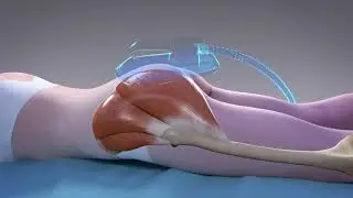 Emsculpt Muscle Demo | Dr. Shel Aesthetic & Wellness Center