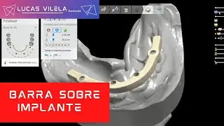 BARRA SOBRE IMPLANTE / 3SHAPE
