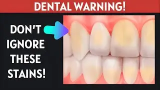 Yellow Teeth &ndash; What Happens If You Ignore the Stains.