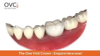 OVC One Visit Crown Procedure
