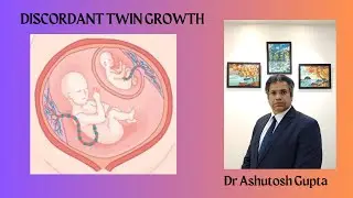 Discordant Twin Growth in DADC twins - How to Manage