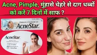 AcneStar Gel Review | Pimples aur Acne ka Permanent Solution? | Side Effects & Benefits in Hindi