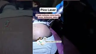 Pico Laser helps treat melasma, acne marks, leg scars, dark underarms, birthmarks and tattoo