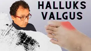 HALLUKS VALGUS