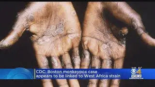 CDC: Boston monkeypox case appears to be linked to West Africa strain
