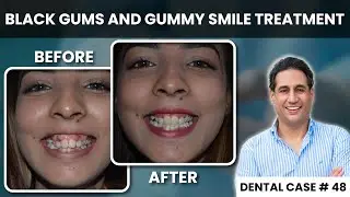 Black Gums and Gummy Smile Treatment | Best Cosmetic Dentist in Pakistan | Dental Case # 48