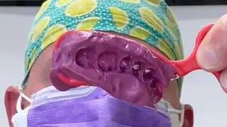The Triple Tray Impression
