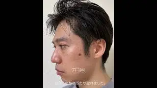 シミ取りレーザーのリアル