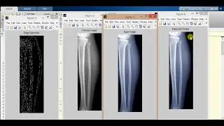Bone Fracture Detection using Image Processing matlab Source code