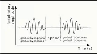 Cheyne stokes breathing in a patient with heart failure.