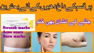 Contractubex gel uses in urdu. Scars removal cream. How to remove burn scars. Acne scars removal