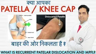 PATELLA DISLOCATION #MPFL क्या होता है? #kneecap #mpfl #patella #patelladislocation #kneedislocation