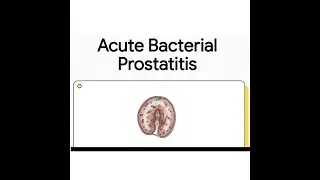 Acute Bacterial Prostatitis | Diagnosis, Management & Clinical Pearls
