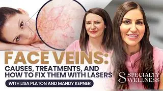 Face Veins: Causes, Treatments, and How to Fix Them with Lasers