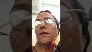Soprano Face Laser Hair Removal | Laser hair removal