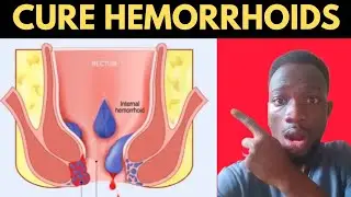 Come sbarazzarsi rapidamente delle emorroidi con il trattamento