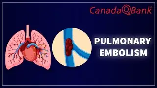 Pulmonary Embolism (PE): Symptoms, Diagnosis & Emergency Management | High-Yield Medicine