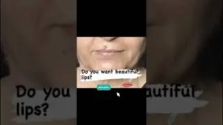 Lip Fillers  Before and After | Lip Enhancement Treatment India | Dr, Reema Arora The Face Clinic