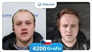Luk&aacute;&scaron; &ndash; V&yacute;sledek po 7 měs&iacute;c&iacute;ch | CLINICANA Istanbul