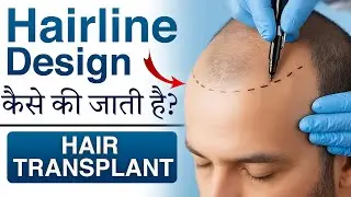 Natural Hairline Design in Hair Transplant | Best Hair Transplant Clinic in Indore &ndash; Genesis Hair