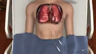 How to Prevent Chest Tube Occlusion - PleuraFlow ACT