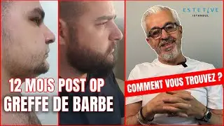 GREFFE DE BARBE RÉSULTAT À 12 MOIS.
