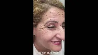 La vidéo complète de l'injection du tiers supérieur du visage