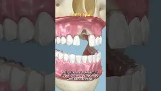 Tooth Implant in 3D | Dental Implant Animation #dentist #dentalcare #orthodontist #teethdecay