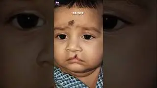 Cute child with incomplete Cleft Lip | Before - After Result.