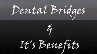 Dental Bridges and its benefits