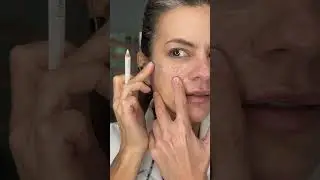 &Aacute;cido hialur&oacute;nico para mejorar surco nasogeniano, surso palpebromalar y jowl...