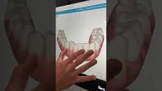 Invisalign Consultation for Busy Professional: Before and After Digital Scan Smile Simulation