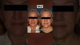 BBL Hero vs Halo. BBL Hero #laserclinique #lasertreatmentforskin #bbl #nonsurgicalsolutions