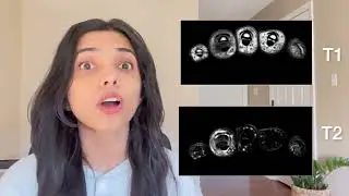 Don&rsquo;t miss Pseudogout on X-ray or MRI!