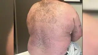‘That tattoo did not represent me.’  Former skinhead undergoes grueling tattoo removal for a new...