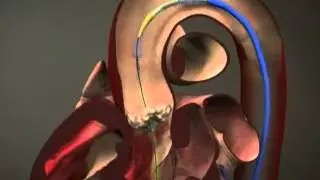 Providence St. Patrick Hospital - One Year of TAVR