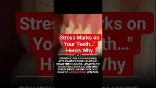 Abfraction. The Hidden Stress Behind Tooth Notches&hellip;#teeth #dentist