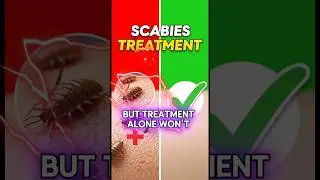 scabies treatment, scabies prevention 2025.#healthtalks #scabies #skindiseases