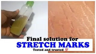 Remove tough stretch marks with this serum | DIY STRETCH MARKS REMOVAL| prime side.