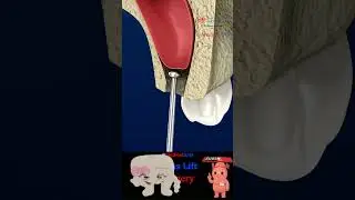 Need an Implant? You Might Need a Sinus Lift First 🦷🍫🪥