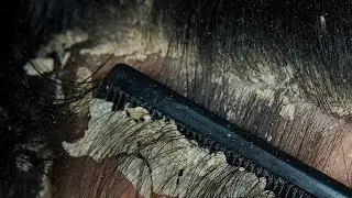 ASMR Satisfying Dandruff Treatment & Scalp Check #27
