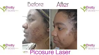 VLOG: Picosure Laser for Acne Scars & Hyperpigmentation | 2nd Time Experience | Satisfying