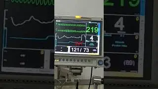 ventricular tachycardia in cardiac monitor