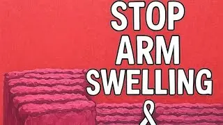 Stop Arm Swelling: Lymphedema Prevention After Breast Surgery