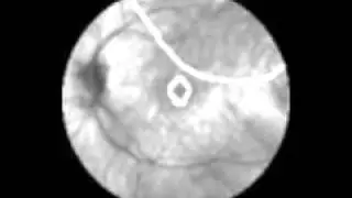 Vision 1 Year after Gene Therapy for Leber's Congenital Amaurosis