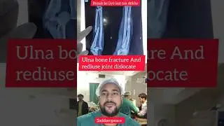 Ulna bone fracture and reduce joint dislocate after operation successful #fracture #viralvideo