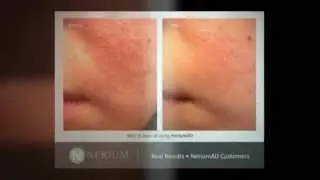 Reduce Rosea and Redness | NeriumAD Results from Real People