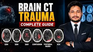 What is Trauma in Brain CT Scans: EDH, SDH, SAH, Contusion?