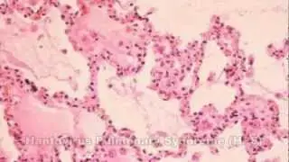 Hantavirus & Hantavirus Pulmonary Syndrome (HPS)